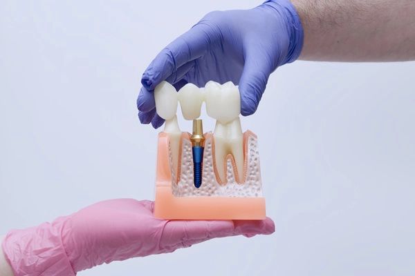 When A Dental Bridge May Be Better Than A Dental Implant